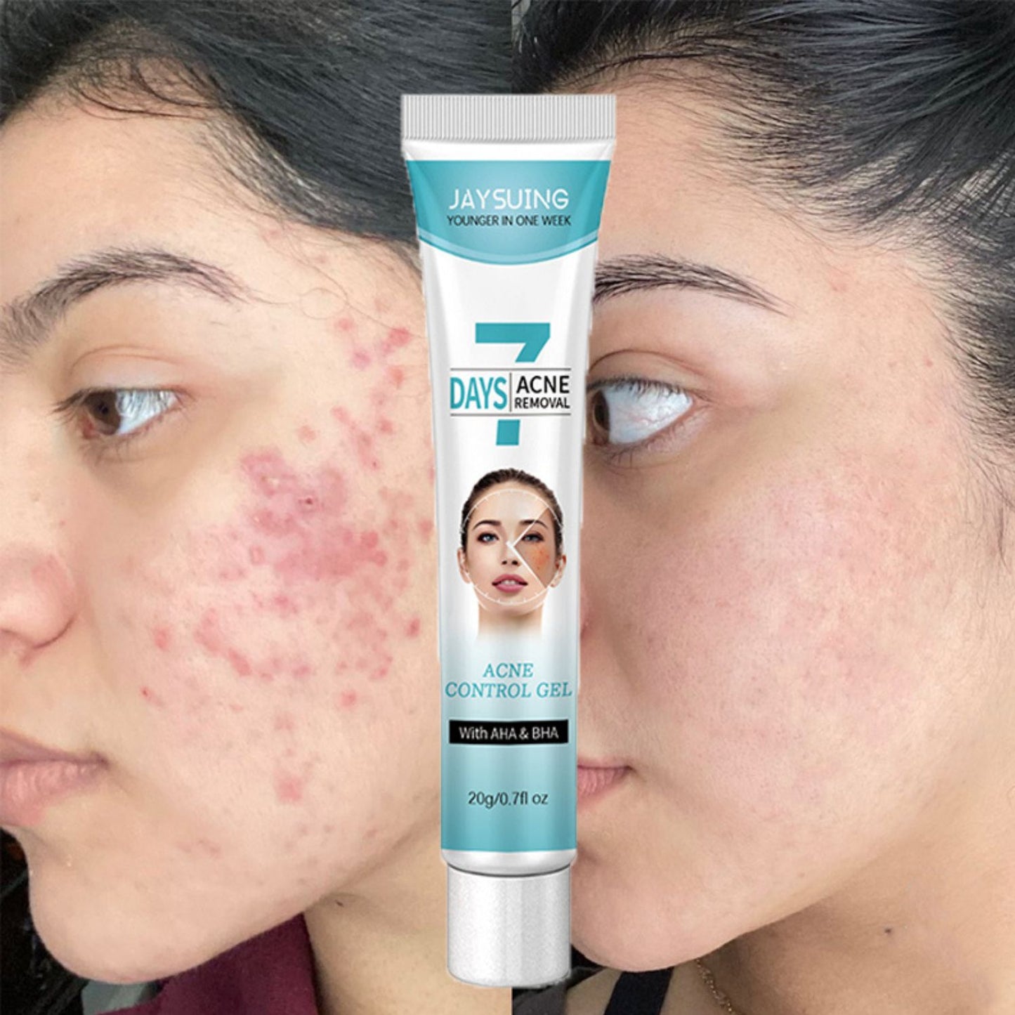 🧴Crema tratamiento acné mascarilla facial 🧴