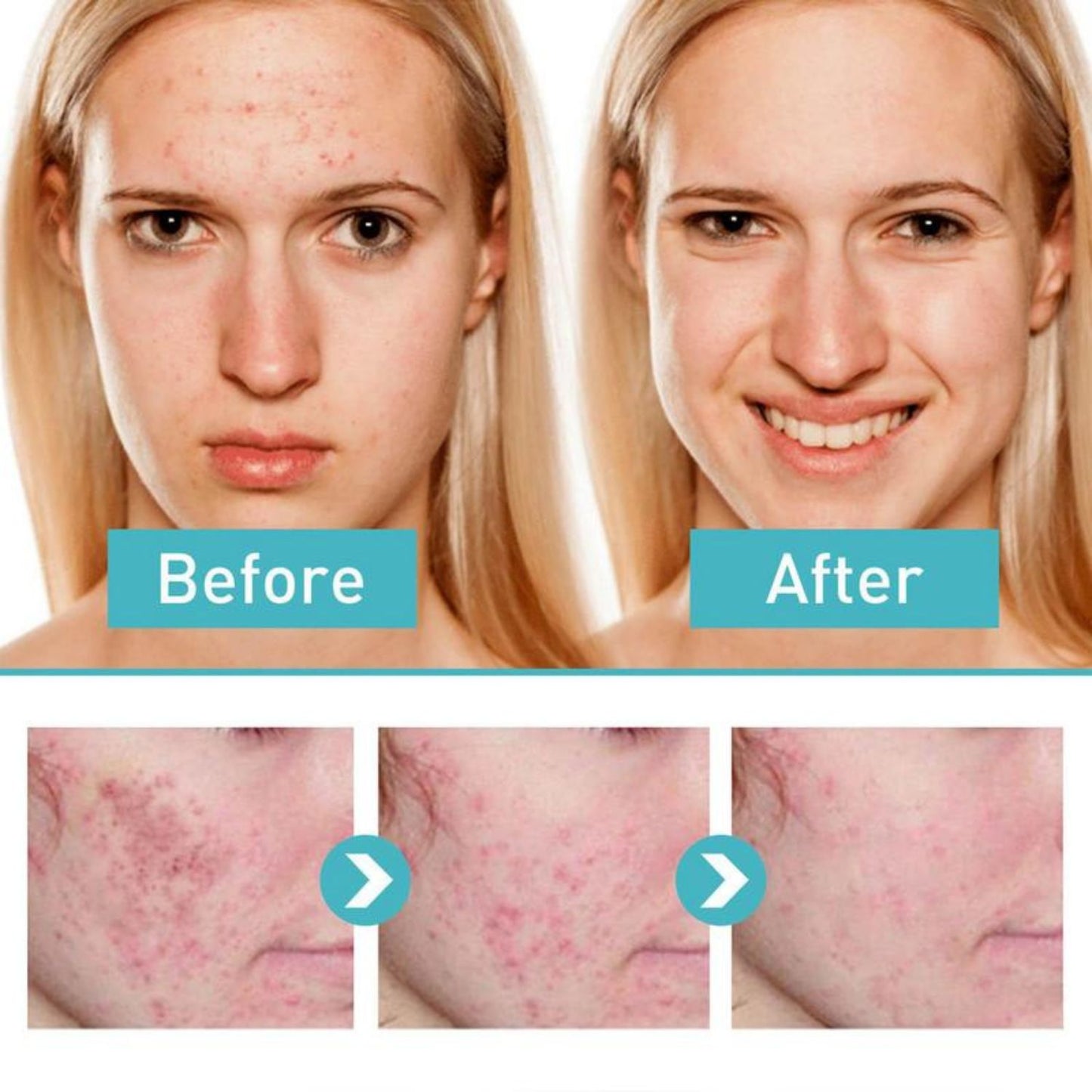 🧴Crema tratamiento acné mascarilla facial 🧴