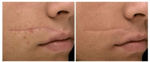 ✨CICATRIZANTE RENOVA spray ✨