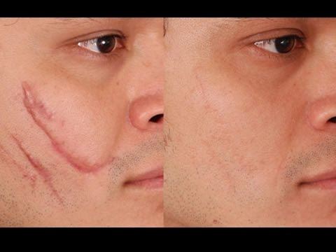 ✨CICATRIZANTE RENOVA spray ✨